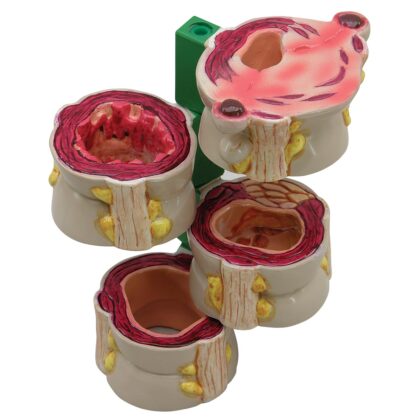 Colon con Patologías 4 piezas - Imagen 2