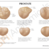 Prostata - Imagen 2