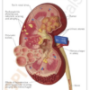 Riñon con Patología - Imagen 3