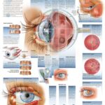 Enfermedades del Ojo