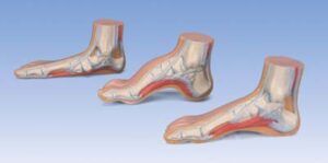 MEDart™ Serie de pies - pie normal, pie plano, pie cavo