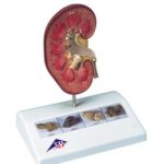 Modelo de cálculo renal