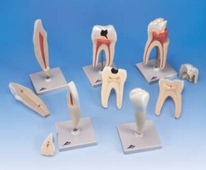Serie de modelos dentales , 5 modelos