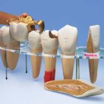 Modelo de prótesis dental, 7 piezas, 10 veces su tamaño natural