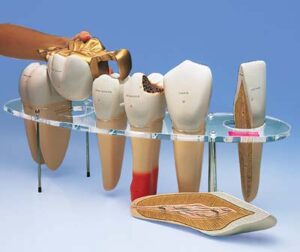 Modelo de prótesis dental, 7 piezas, 10 veces su tamaño natural