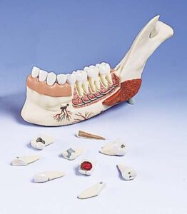 Mitad de la mandíbula inferior con 8 dientes cariados, 19 piezas