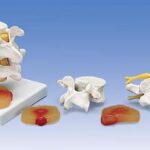 Discos Vertebrales Lumbares con Hernia Discal