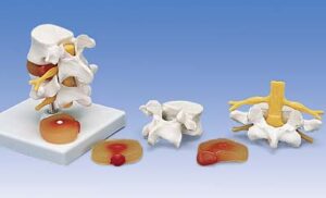 Discos Vertebrales Lumbares con Hernia Discal