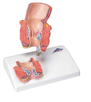 Modelo de hemorroides