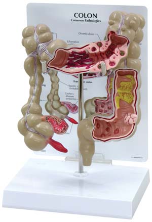 Modelos de Cáncer