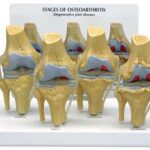 4 Etapas de Osteoartritis de Rodilla