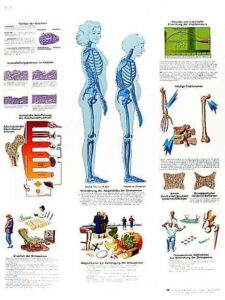 Osteoporosis