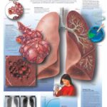 EPOC Enfermedad pulmonar obstructiva crónica