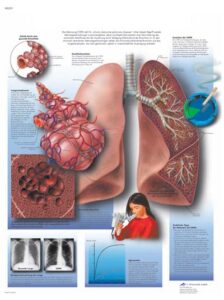 EPOC Enfermedad pulmonar obstructiva crónica