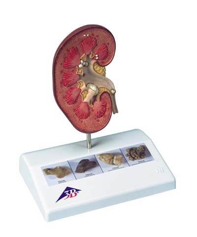 Modelo de cálculo renal Modelo de cálculo renal