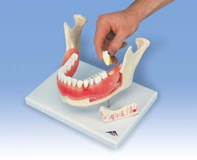 Afección dental, a 2 aumentos, de 21 piezas