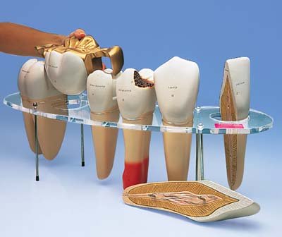 Modelo de prótesis dental, 7 piezas, 10 veces su tamaño natural Modelo de prótesis dental, 7 piezas, 10 veces su tamaño natural
