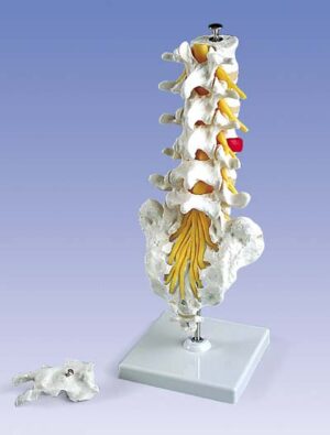Columna Vertebral Lumbar con Hernia Discal