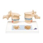 Modelo osteoporosis