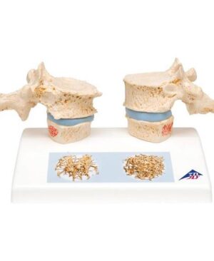 Modelo osteoporosis