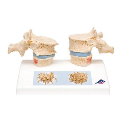 Modelo osteoporosis