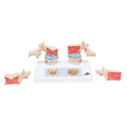 Modelo osteoporosis - Imagen 3