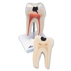 Molar inferior 2 raíces