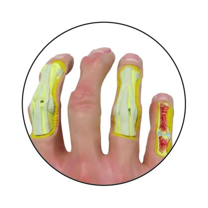 Modelo de mano con osteoartritis - Imagen 2