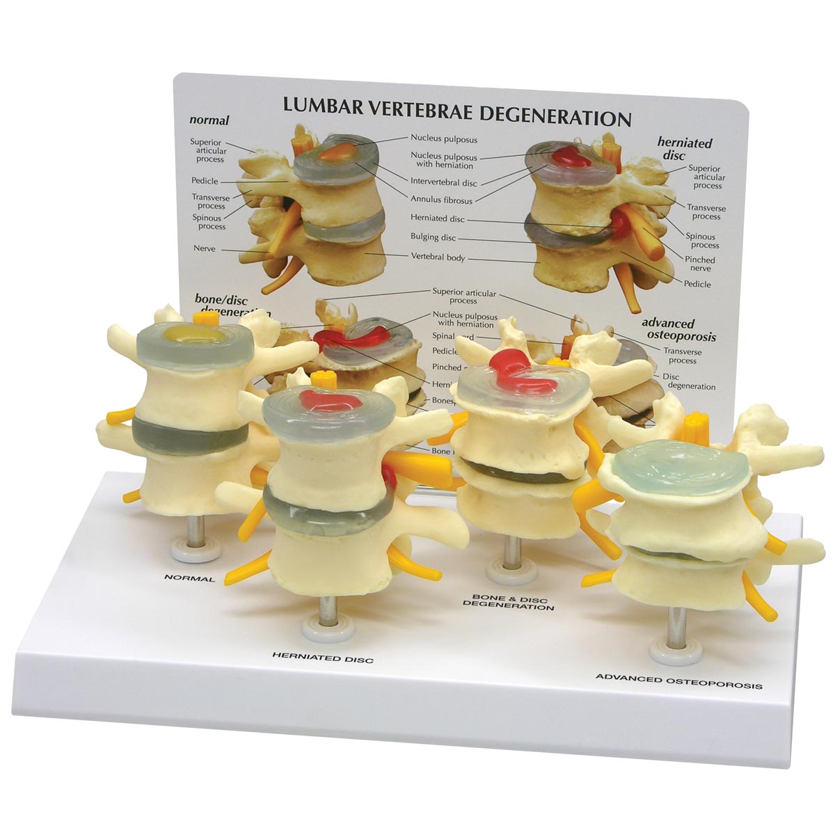 1019512_01_1200_1200_Conjunto-de-modelo-de-vertebras-4-fases