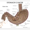 Cáncer de estómago - Imagen 2