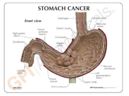 Cáncer de estómago - Imagen 2