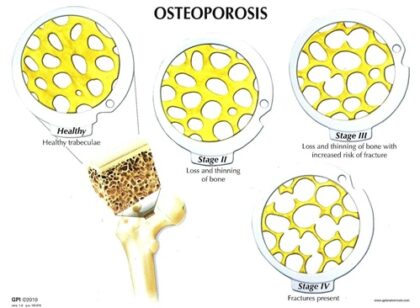 Conjunto de discos – 4 fases de la osteoporosis - Imagen 2
