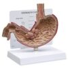 Cáncer de estómago