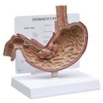 Cáncer de estómago