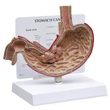 Cáncer de estómago