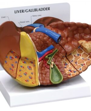 hígado/vesícula biliar con cálculos (biliares)