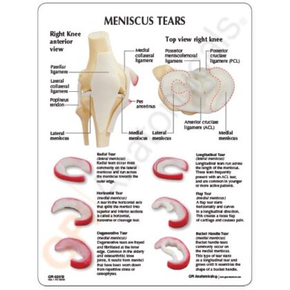 Modelo de rodilla, menisco con 6 desgarros - Imagen 3