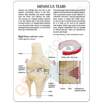 Modelo de rodilla, menisco con 6 desgarros - Imagen 2