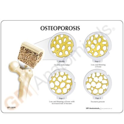 Conjunto de discos – 4 fases de la osteoporosis - Imagen 3