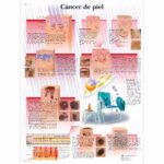 Cáncer de piel Lámina