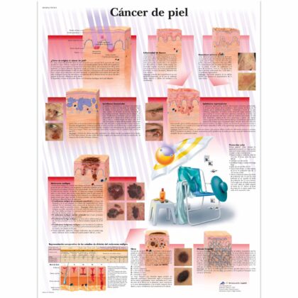Cáncer de piel Lámina