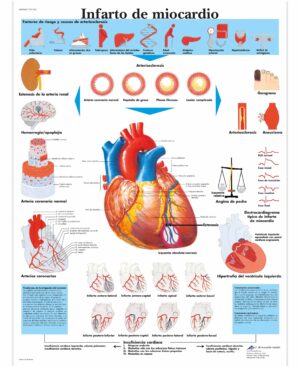 Infarto de miocardio Lámina