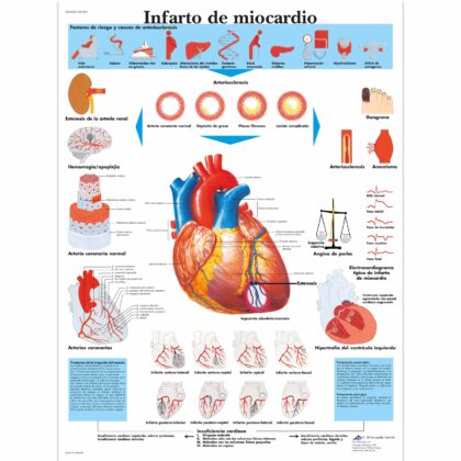 Infarto de miocardio Lámina
