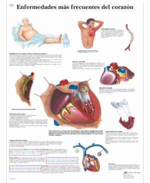 Enfermedades más frecuentes del corazón Lámina