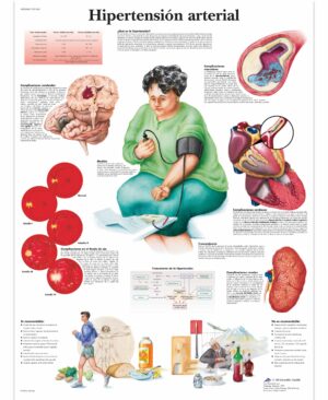 Hipertensión arterial Lámina