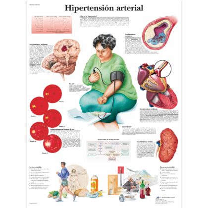 Hipertensión arterial Lámina