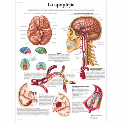La apoplejía