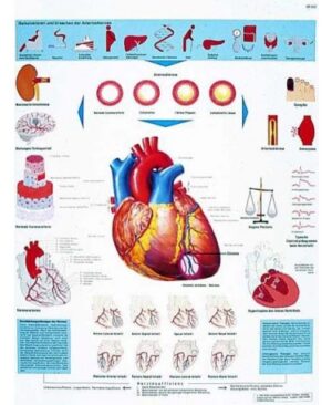 Infarto al miocardio Lámina