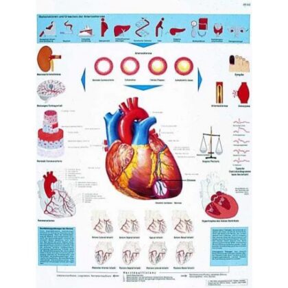 Infarto al miocardio Lámina