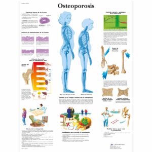 Osteoporosis lámina